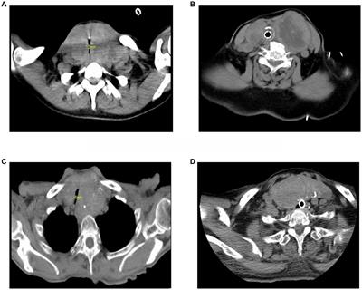 Case report: Preliminary study on the diagnosis and treatment of respiratory distress in patients with giant nodular goiter complicated with severe COVID-19